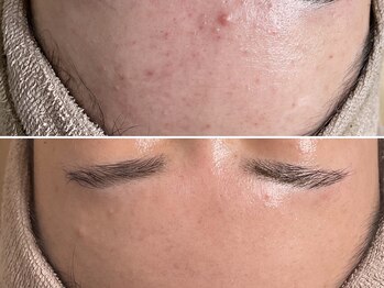 エイプリルフールズ(April fools)/【20代】内側から輝く美おでこ！