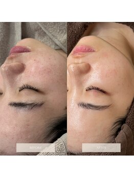 タグ 高知駅前店(Tug)/【頬のニキビケア・肌荒れ】