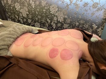 リラ鍼灸接骨院(Rela鍼灸接骨院)/吸い玉カッピング