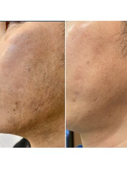 エピシアドットエヌ(epicia.N)/肌荒れ改善