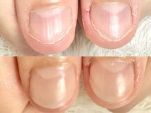 グレースレディ/(深爪/長さだし/フィルイン)