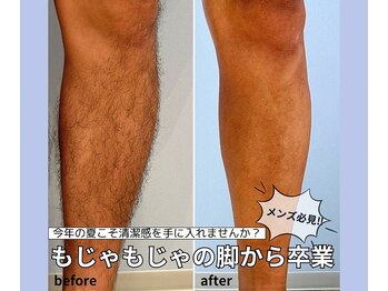 ベルミーランド 浜松天王/脱毛Before→After