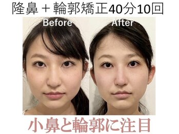 ラプリ 梅田店(Raplit)/隆鼻＋輪郭矯正40分10回