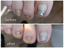 爪切り屋 足楽/巻いて窪みのある爪も