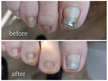 巻いて窪みのある爪も