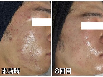 ハーブピーリングHYの写真/結果重視！メンズ多数来店中♪繰り返すニキビ・毛穴悩み解消◎自信肌へ導くハーブピーリング