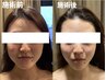 【1ヶ月以上】人気No.1★脂肪撃退×韓国肌管理で両方叶う大人の肌育小顔管理