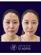 サロン ド ナース ユー ソナ(salon de nurse U.sona)の写真/【医療提携◆看護師サロン】効果が持続し、元に戻さない、究極小顔リフト術。フェイスラインのお悩み解決！