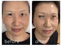 ココチ(KOKOCHI)/ダイヤモンドピール(5回)