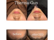 リアンダ(Rianda)/エステ版サーマジェン