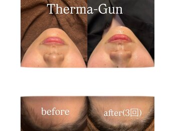 リアンダ(Rianda)/エステ版サーマジェン