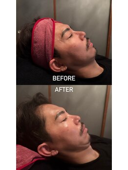 アンテグラール/日本初採用エクソソーム施術