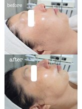 ファームディ(Pharm.D)/たった1回で実感！