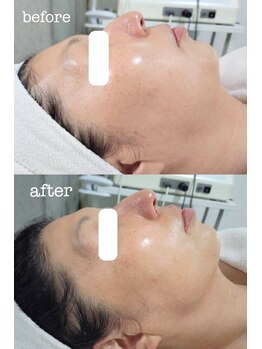 ファームディ(Pharm.D)/たった1回で実感!