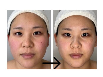 コトハ(cottha)/1回施術後