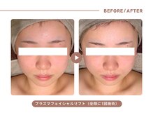 イエス マイサロン(yes My Salon)/プラズマリフトアップ症例