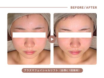 イエス マイサロン(yes My Salon)/プラズマリフトアップ症例