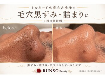 ランソ ビューティー 成田(RUNSO Beauty)の写真/《成田駅徒歩3分》黒ずみ・詰まり・開き毛穴に◎トルネード水流毛穴洗浄でつるんと清潔感のある素肌へ