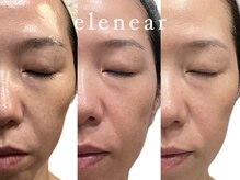 エレニア 住吉店(Elenear)/純度100%ヒト幹細胞培養液導入！