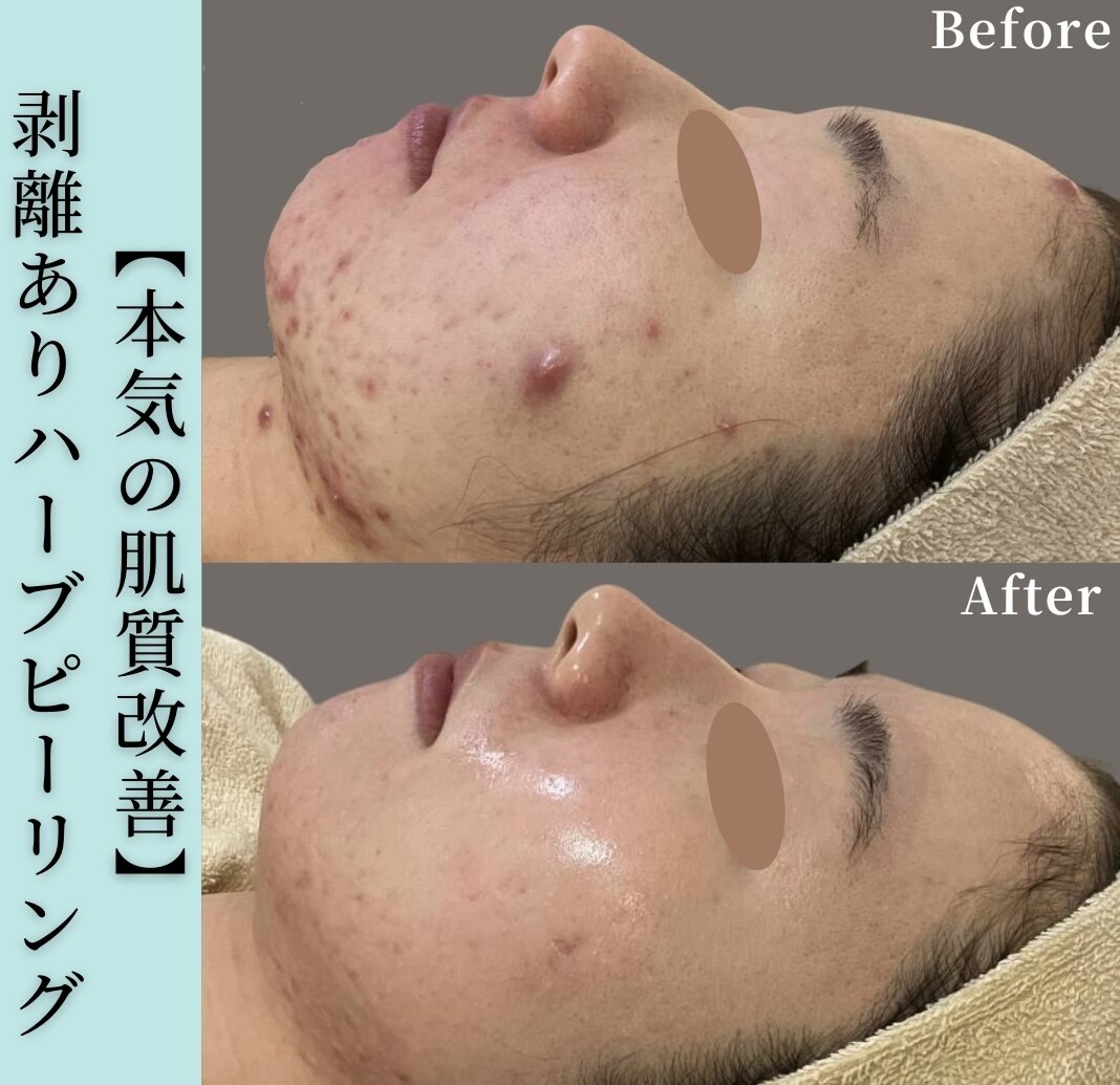 ハーブピーリング 剥離ありに関するエステサロン 美肌ケアサロン ハーブピーリング 剥離ありに関するエステサロン 美肌ケアサロン