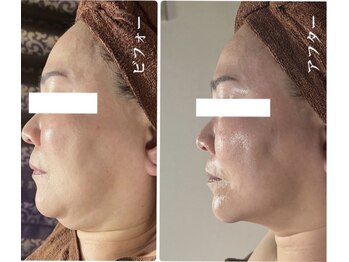 アルページュ(Arpege)の写真/仙台初♪韓国話題★エステ版チタニウムリフト【小顔輪郭×高ハリ×色白×毛穴レス】一度で叶う欲張り美容