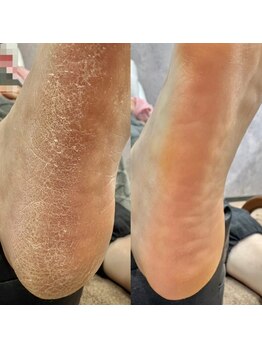 ヴィプラス(Vi+)の写真/魅せる素足へ★潤いフット角質ケア＋足裏つるつる保湿仕上げ￥7800