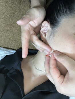 リバイバル(Re:vival)/あごの疲れ・頭にも鍼は可能!