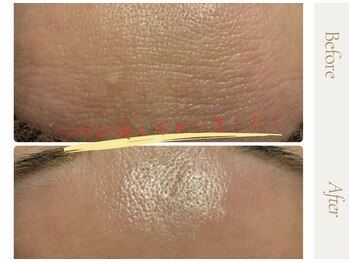 ルヴィショップ 沖縄(REVI SHOP)/次世代ハーブピーリング