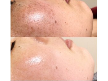 キュアフロウ 橿原店/6回来店☆しみ・くすみケア