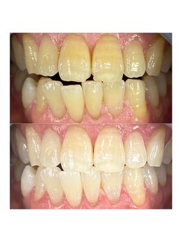 ホワイトニングカフェ 藤が丘店(WhiteningCafe)/プレミアムホワイトニング☆