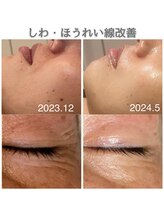 サロンドシー(SALON de C.)/ほうれい線・しわ改善