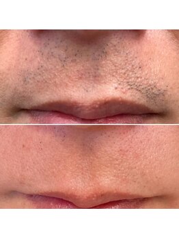 エピシアドットエヌ(epicia.N)/プツプツ毛穴にさようなら