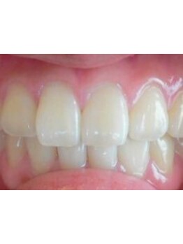 美白ケアをしたい