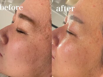 エンソワー(en'sower)/セルマントリートメントで艶肌へ