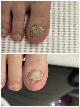 巻き爪じゅん 千葉駅前店/専門施術で快適な歩行を取り戻す