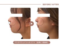イエス マイサロン(yes My Salon)/プラズマリフトアップ症例