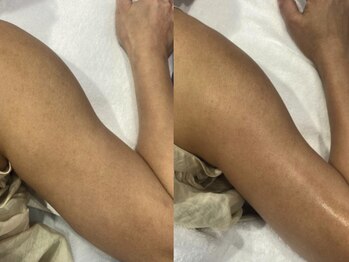 エモーショナル 姫路(Emotional)/エステ版オンダ◎マイクロボディ