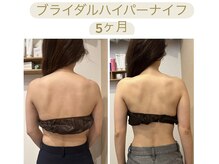 ビボーン ボディ(美bone body)/プレ花嫁様 ハイパーナイフ痩身
