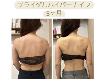 ビボーン ボディ(美bone body)/プレ花嫁様 ハイパーナイフ痩身