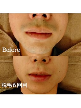 イズム(ism)/脱毛◆2回目 ⇒ 6回目◆