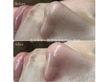 ピエル 北千住店(PIEL)/毛穴エクストラクション