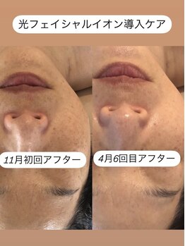 ステライチマルサン(stella.103)/光フェイシャル