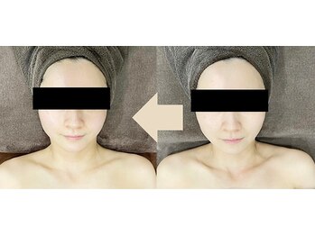 ベルシア(BELXIA)/ビフォーアフター