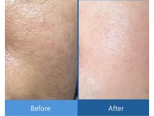 リノア 柏(Lino'a)/ごわつき/毛穴ひらき→白玉肌へ