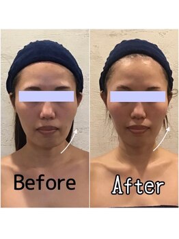 小顔フェイスラボ 大津京駅前店(小顔 Face Labo.)/小顔&整体コルギの変化