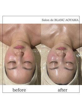 サロン ド ブラン アオヤマ(Salon de BLANC AOYAMA)/BLANC式小顔ソノケアコース