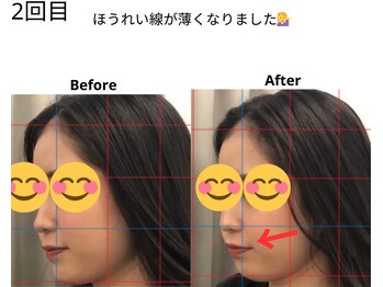 ベル/20代の方の小顔Before After