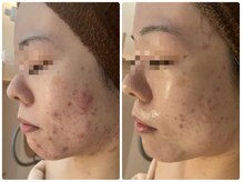 アレーズファイブフォー(A’LAISE54)/ニキビケア