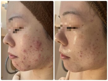 アレーズファイブフォー(A’LAISE54)/ニキビケア