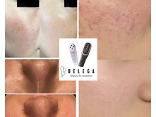 ベレガ 姫路店(BELEGA)の雰囲気（セルキュアを使用したビフォーアフター♪）